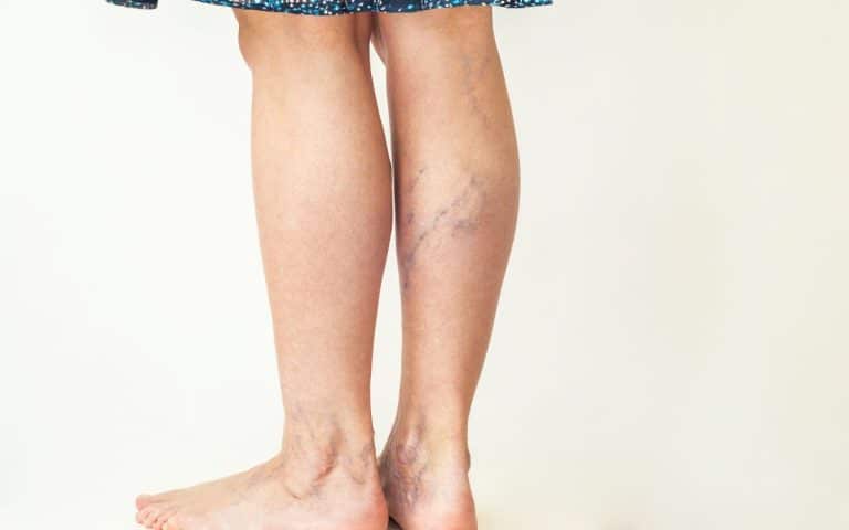 גורמים לורידים ברגליים