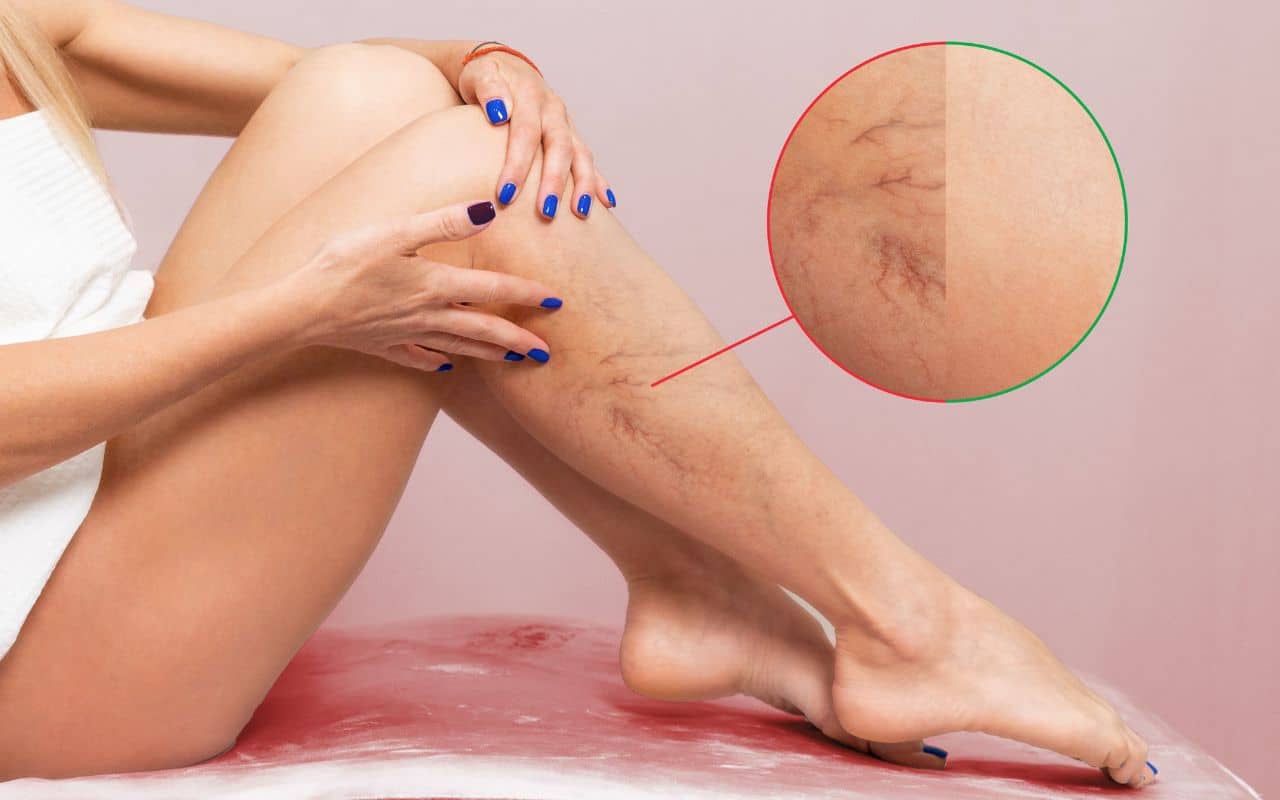 העלמת ורידים ברגליים