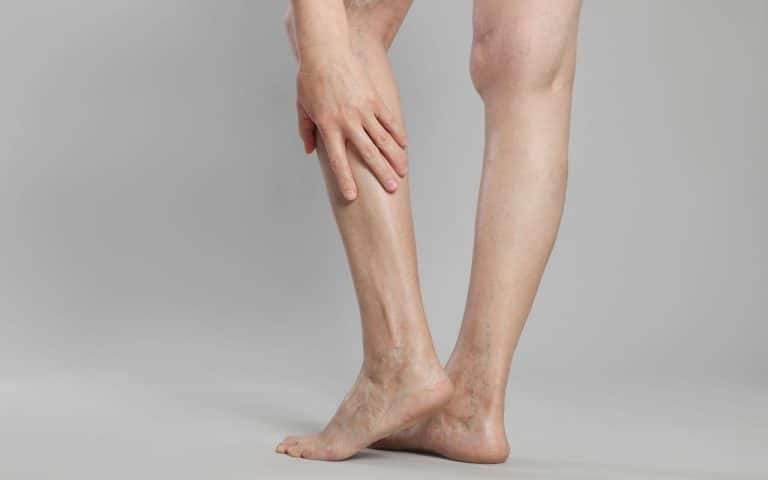 ורידים ברגליים – מתי צריך לטפל בבעיה