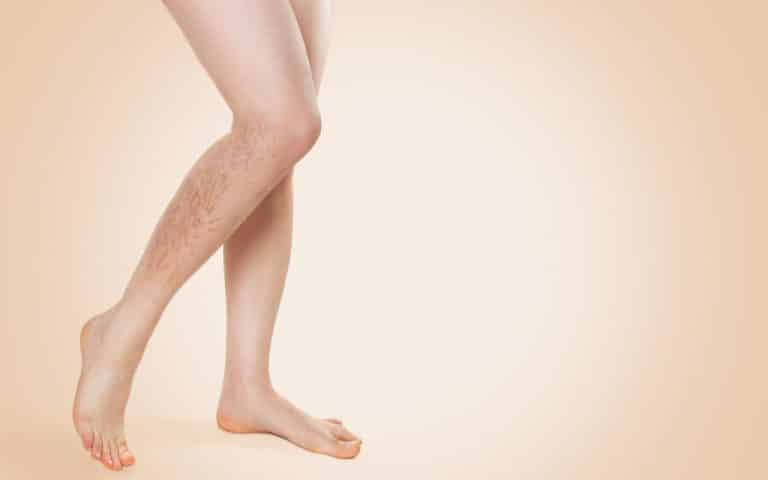 יש לך ורידים ברגליים