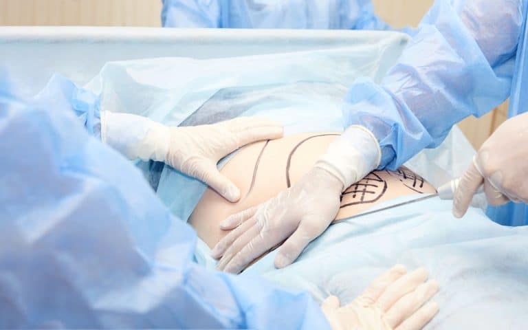 מתיחת בטן, שאיבת שומן או שניהם