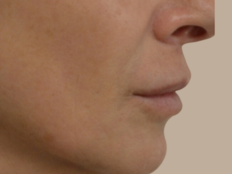 אחרי בוסט אנטי אייג'ינג