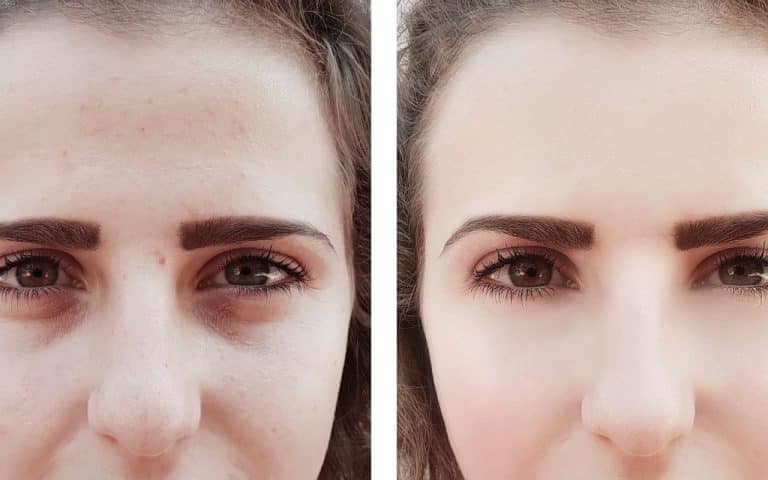 התמודדות עם שקעים ועיגולים שחורים