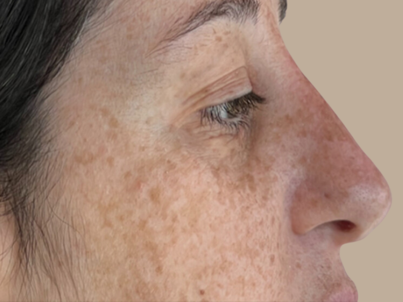 עדי אחרי פיסול אף