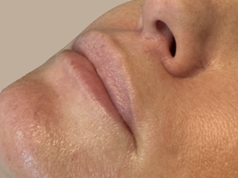 שלי אחרי עיבוי שפתיים