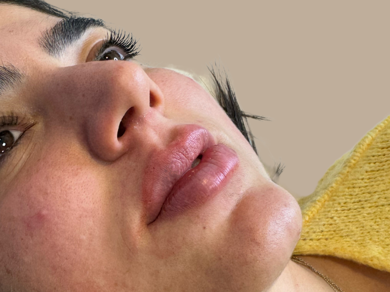 תהל אחרי עיבוי שפתיים