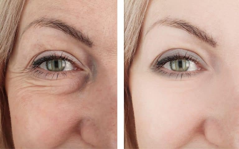 טיפול העלמת קמטים