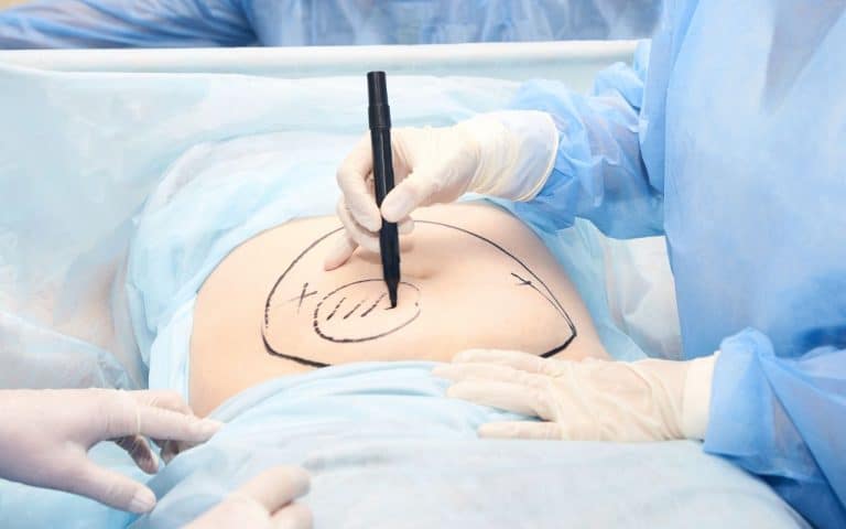 ניתוח שאיבת שומן