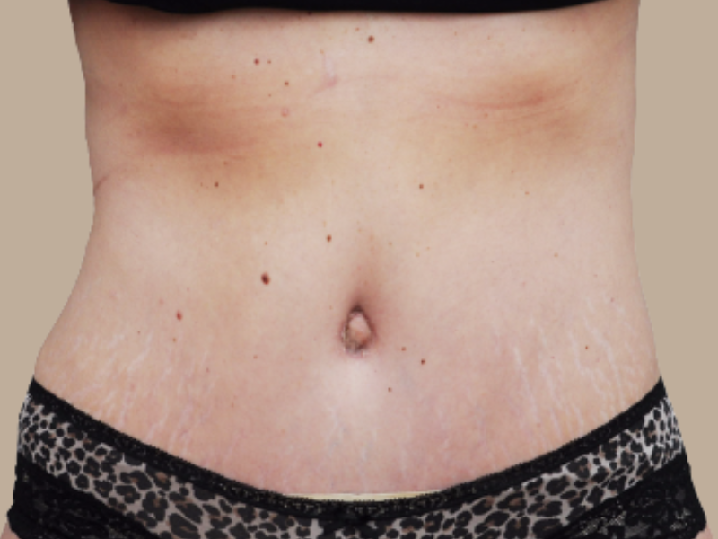 אחרי שאיבת שומן