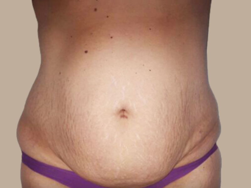 לפני שאיבת שומן