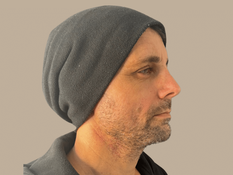 ניתוח אף אחרי