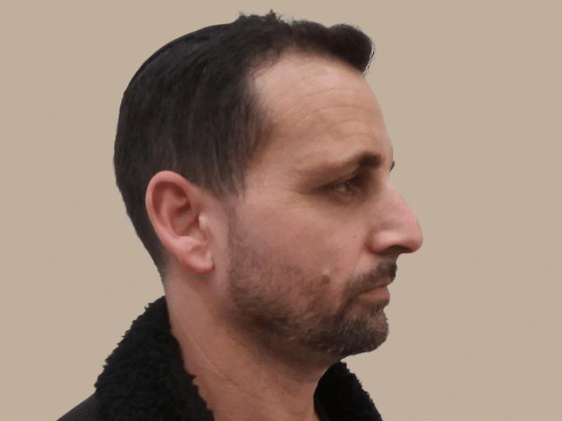 ניתוח אף לפני