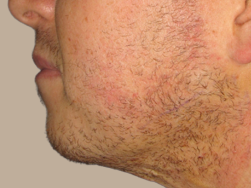 שאיבת שומן אחרי