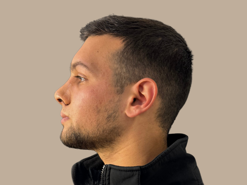 ניתוח אף אחרי