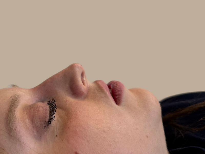 פיסול אף אחרי