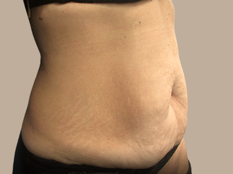 לפני שאיבת שומן