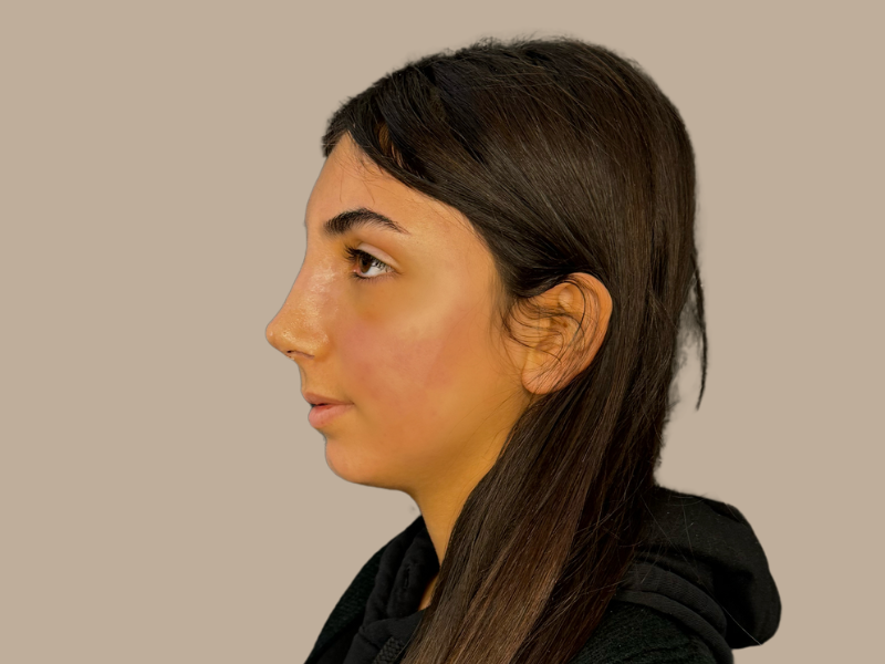 ניתוח אף אחרי