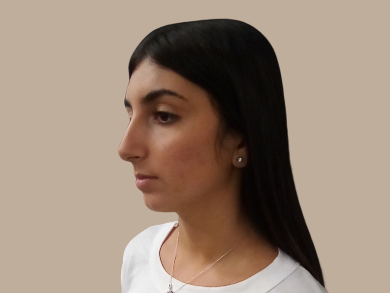 ניתוח אף לפני