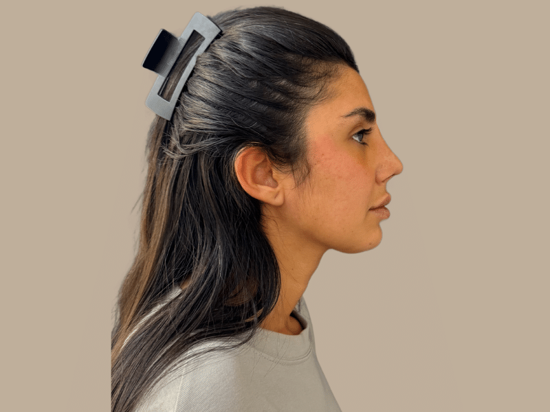 ניתוח אף אחרי