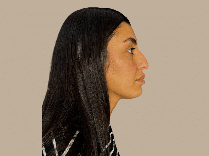 ניתוח אף לפני