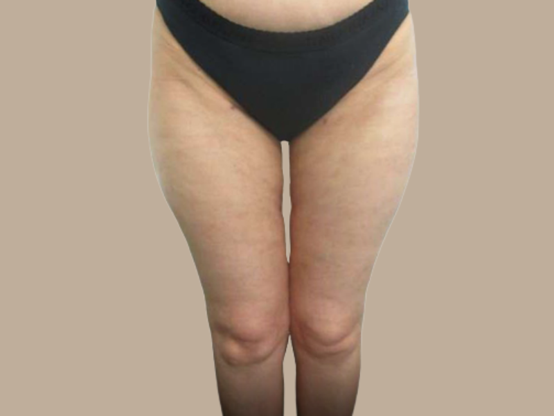 אחרי שאיבת שומן