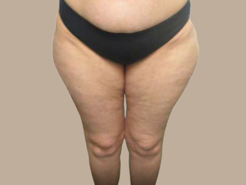 י לפני שאיבה