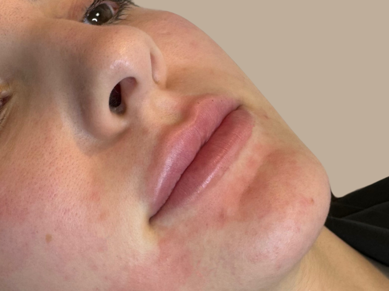 עיבוי שפתיים אחרי