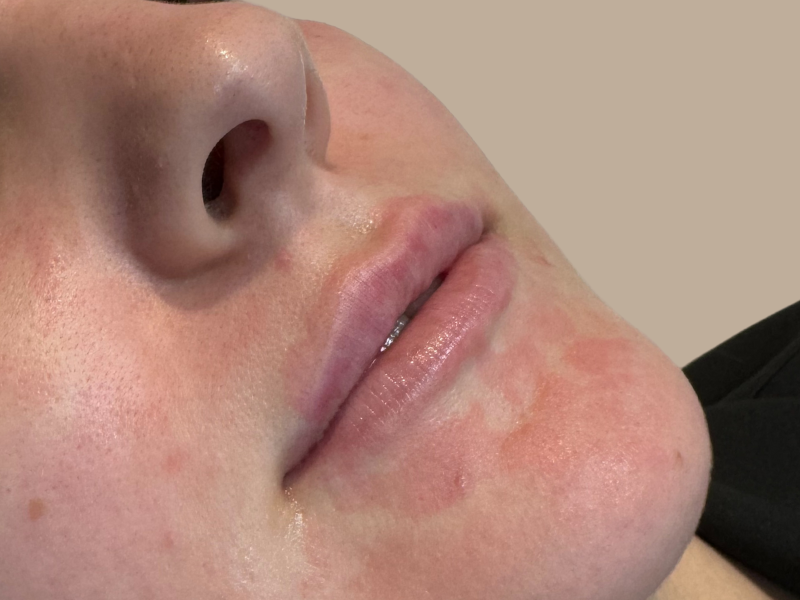 עיבוי שפתיים לפני