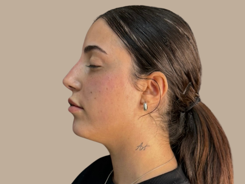 פיסול אף אחרי