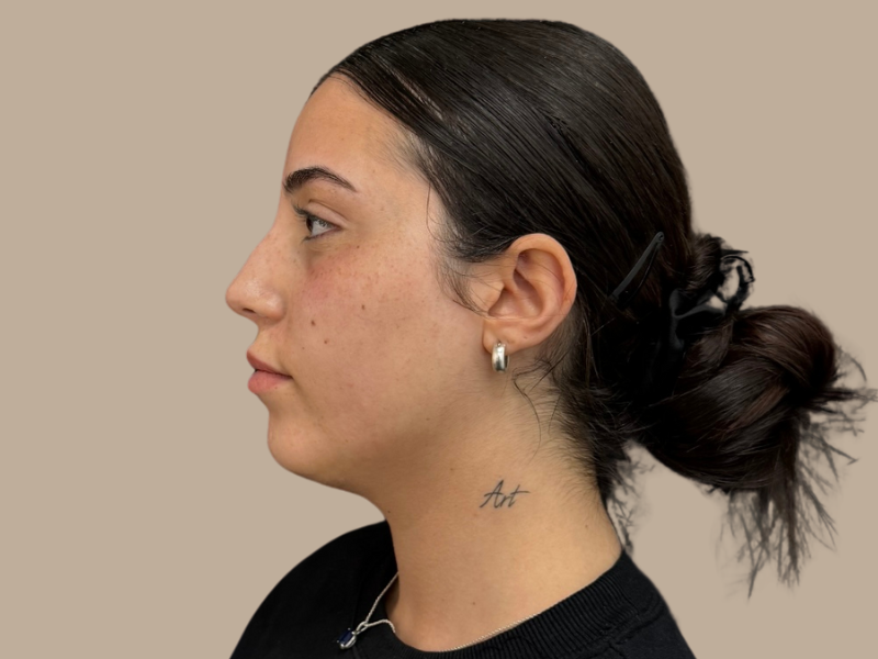 פיסול אף לפני