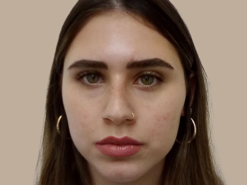 ניתוח אף לפני