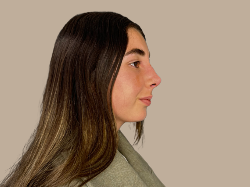 ניתוח אף אחרי