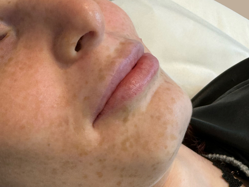 לפני עיבוי שפתיים