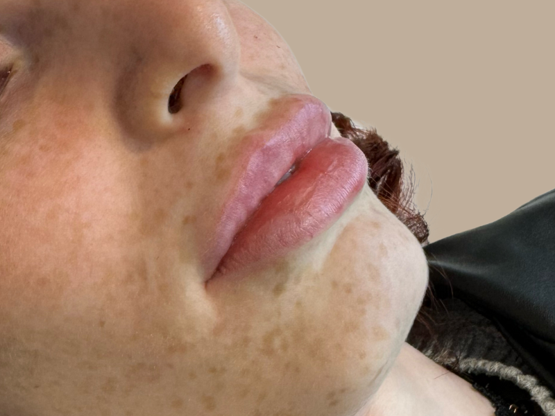 אחרי עיבוי שפתיים