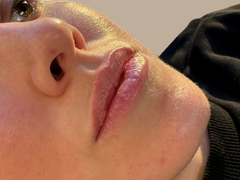 לפני עיבוי שפתיים