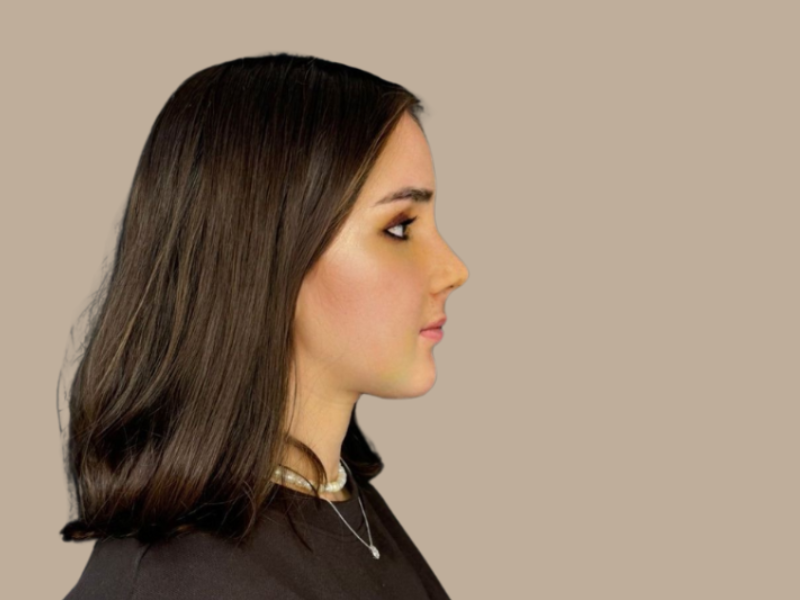 אחרי ניתוח אף