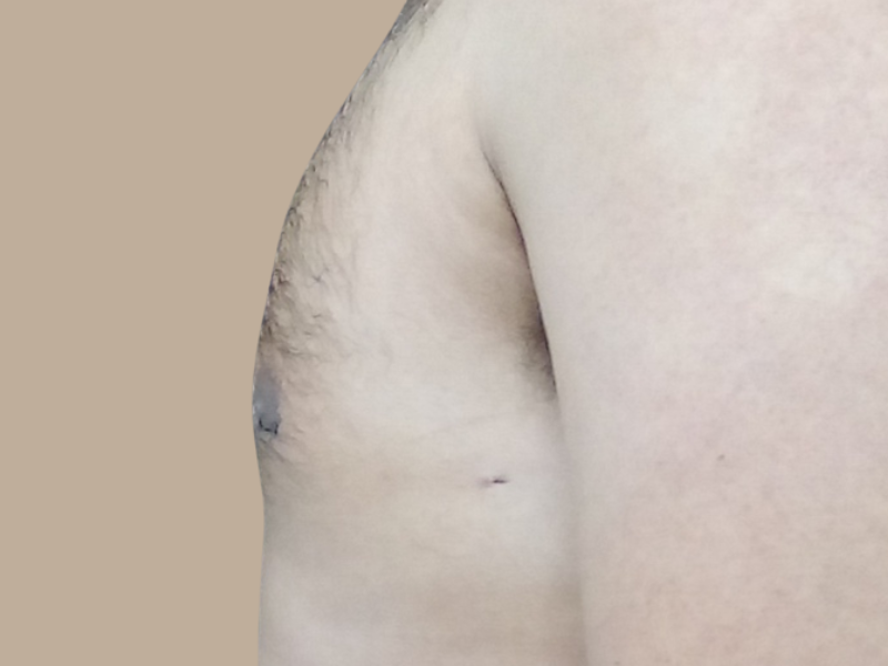 גניקומסטיה אחרי