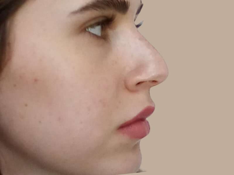 ניתוח אף לפני