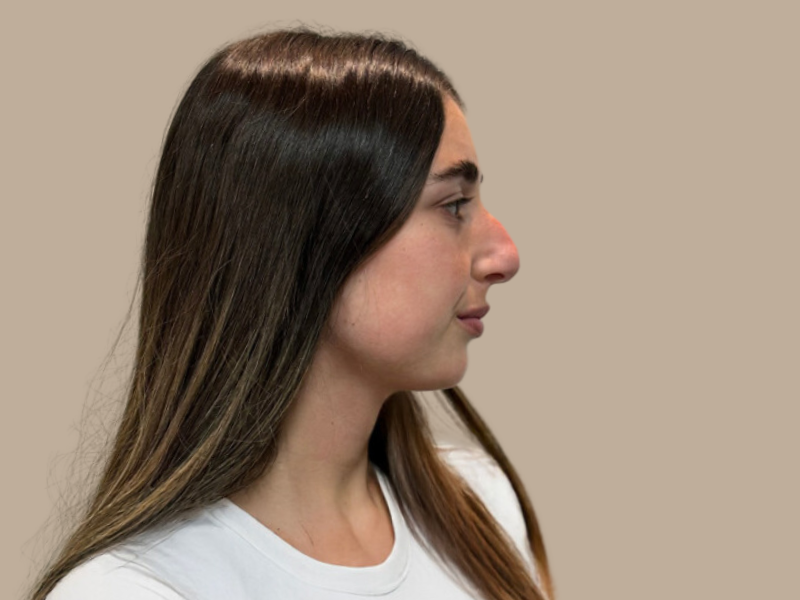 ניתוח אף לפני