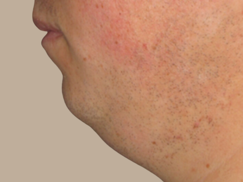 שאיבת שומן לפני