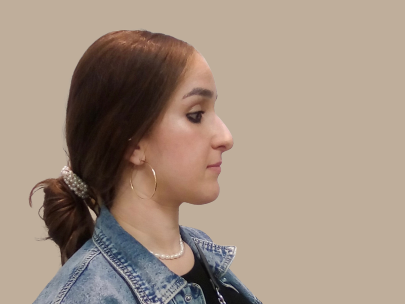 ניתוח אף לפני