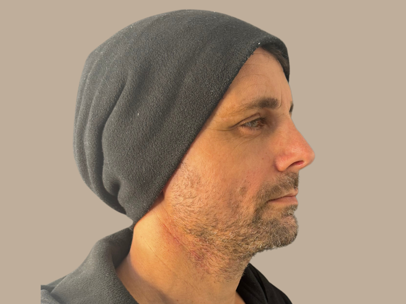 אחרי ניתוח אף