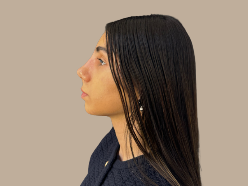 נעמה אחרי ניתוח אף