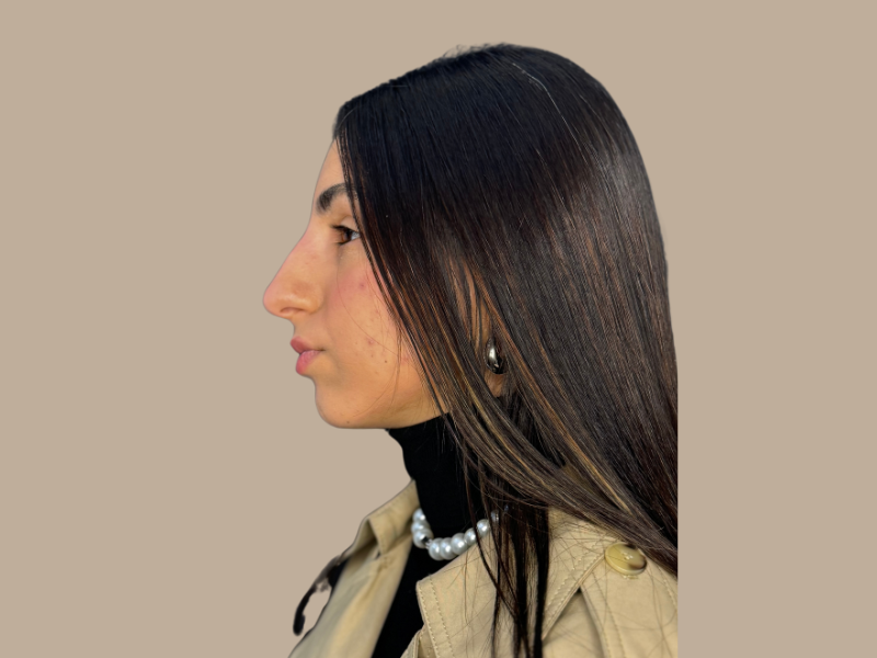 נעמה לפני ניתוח אף