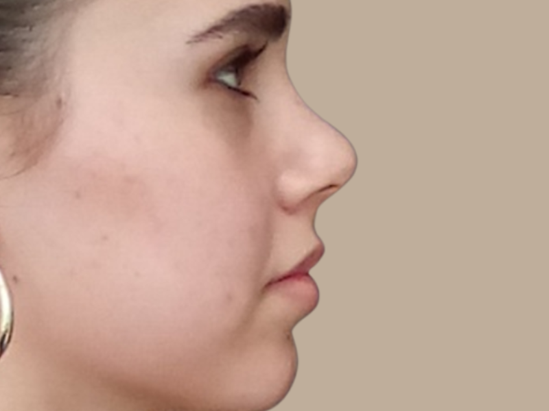 ניתוח אף אחרי