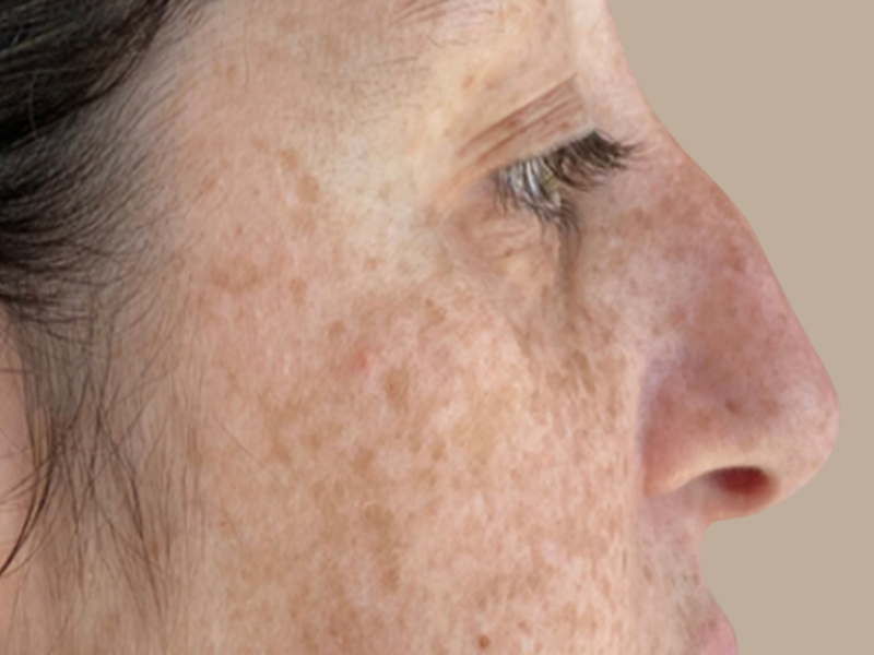 פיסול אף לפני