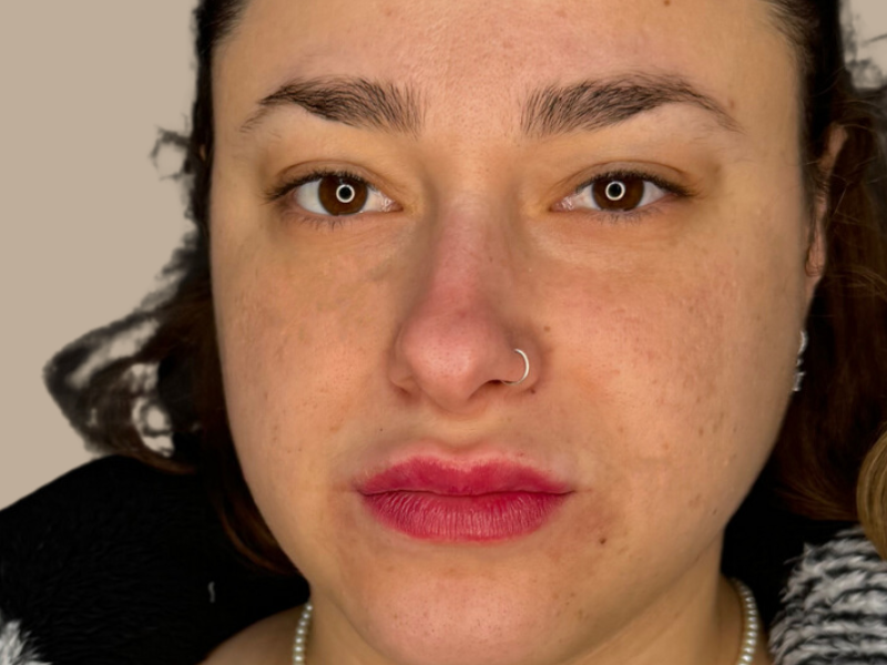 עדן אחרי עיבוי שפתיים