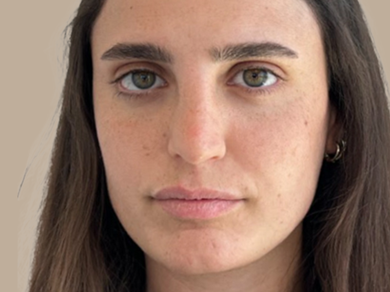 עיבוי שפתיים לפני