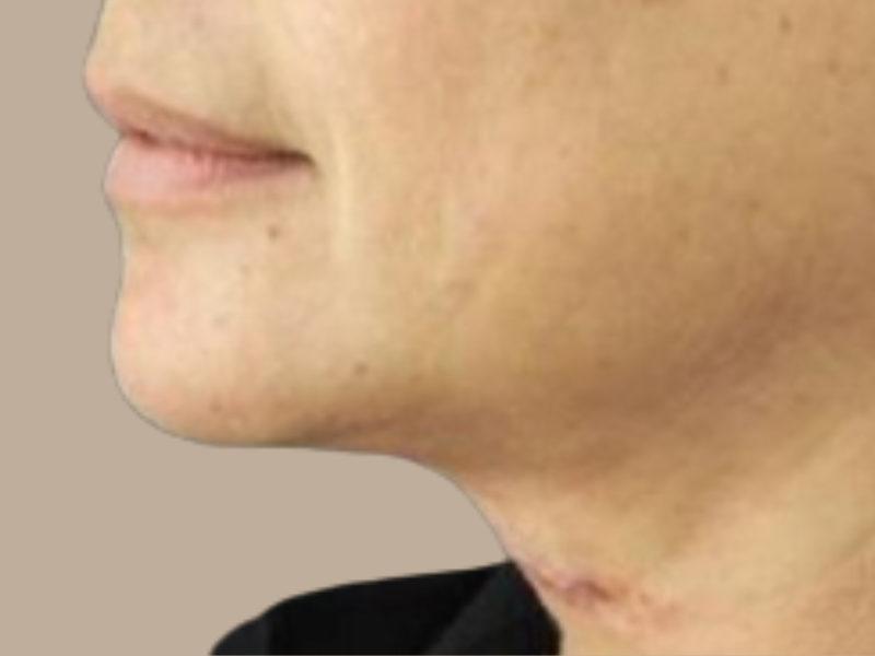 אחרי שאיבת שומן