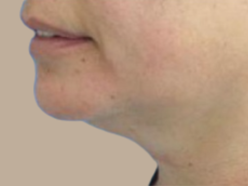 לפני שאיבת שומן